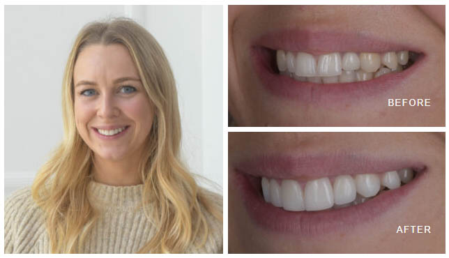 London Cosmetic Dentists Reveal 8 Ways Dental Implants in London Restore Natural Smiles